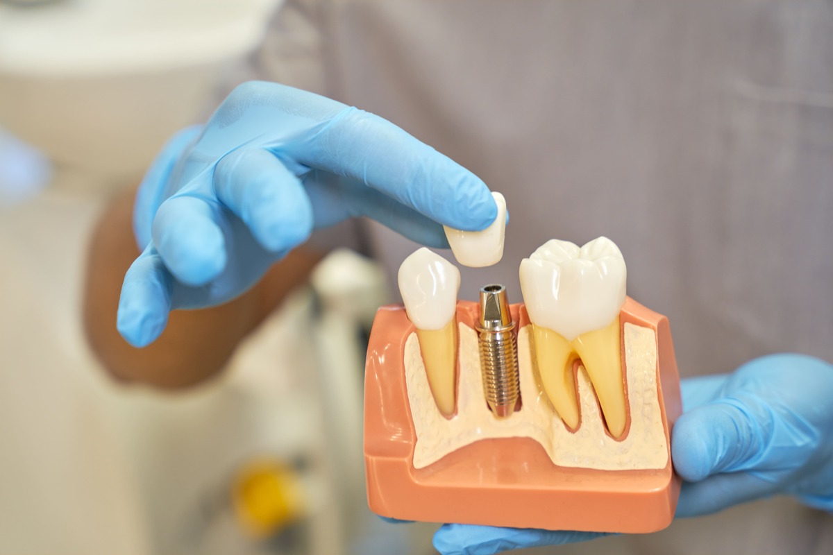 How We Help You Choose the Right Tooth Replacement Option